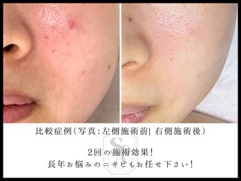 韓国肌管理室 ソア(soa)/【ニキビケアのラスボスFCR!】