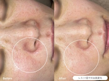 フォンビューティー(fon beauty)/しみ×赤みケア1回