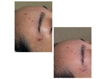 エミルカ 自由が丘店(EMILUCA)/炎症後の赤み