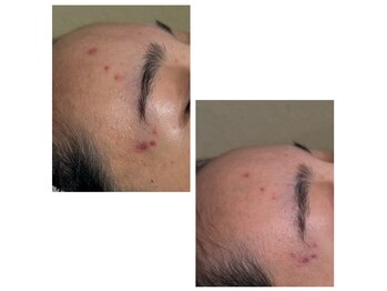 エミルカ 自由が丘店(EMILUCA)/炎症後の赤み