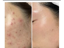 フローレント(Florent)/ハーブピーリング