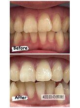 プレジール(PLAISIR)/セルフホワイトニング