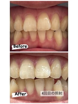 プレジール(PLAISIR)/セルフホワイトニング