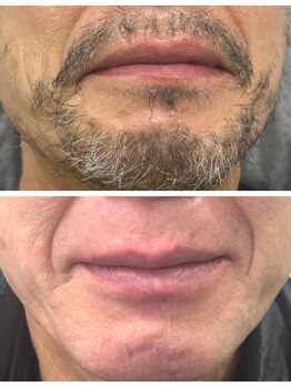 スタイルバイアンバー(style by Amber)の写真/【お肌の角質も除去!男性のための髭ワックス脱毛サービス】自信を持てる、清潔感あふれる素肌に◆