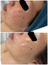 サロン エム(Salon M)/ダクトピール1回　赤みケア