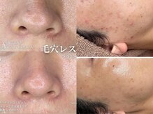 最新のエステマシンを導入しております◎