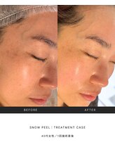 アパラギ(Aparagi)/【韓国肌管理】雪花ピール