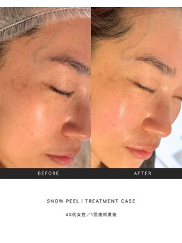 ルミセル(LUMICEL)/【韓国肌管理】雪花ピール