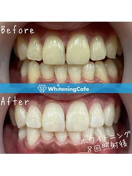 ホワイトニングカフェ 池袋東口店/ホワイトニングビフォーアフター