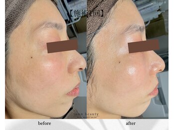 アン ビューティー(ann beauty)/施術2回【症例写真】40代