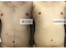 メンズアルファ/【腹】光脱毛before after 20代