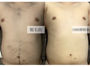 メンズアルファ/【腹】光脱毛before after 20代