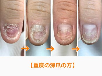 レアム/一生このままだと思っていた。