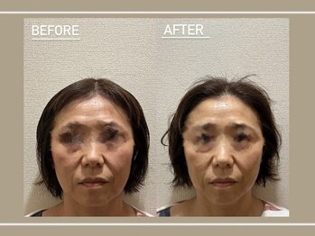 ルアナ(Luana)の写真/【１日1名限定モニター】ドライヘッド×小顔矯正コルギ×上向きもち肌パックでむくみ・たるみスッキリ
