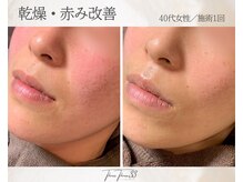 スリースリー 恵比寿(THREE THREE)/乾燥・赤みケア