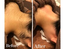 バナナ 福井店(Banana)/うなじワックス脱毛