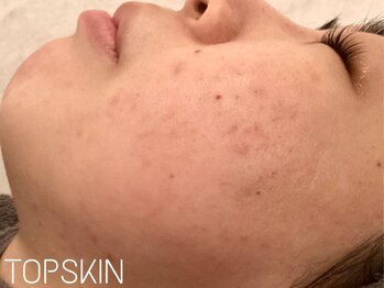 トップスキン 新宿(TOPSKIN)/ハーブピーリングはTOPSKINで♪