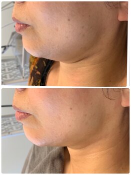 プリュネル(Prunelle)/プラズマシャワー