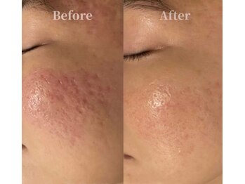 オームの森 北浜/諦めていた凸凹肌改善