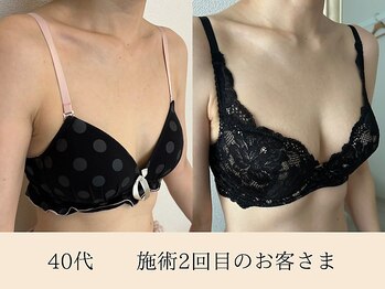 ラーナ(Lana)/バストアップ症例