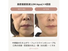 リサプリ(Re: Supple)の雰囲気（特許19MHz/LDM★肌のしぼみ・毛穴・たるみケア◎目覚める肌細胞）
