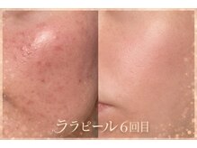 ビジュー(BIJOU)/ララピール　ご新規様　¥6800