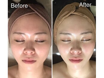 アドネ(Adone)の写真/【結果重視】最新筋膜マシンで大人女性のたるみ・お顔の脂肪を優しくケア★すっきり整う上品な小顔へ♪