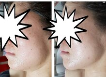 キアラ(CHIARA)/ウルトラコルギピーリング