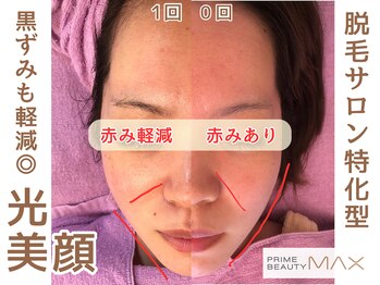 マックス 与野店(MAX)/光美顔エステの効果！施術前後！
