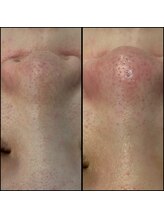 リッツ 所沢店/【Before/After】毛穴