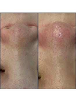 リッツ 所沢店/【Before/After】毛穴