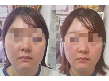 エスビューティーサロン(S Beauty Salon)/小顔