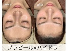 マドモアゼル 麻布十番/ララピール×サーマ