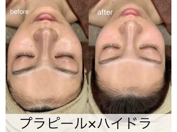 マドモアゼル 麻布十番/ララピール×サーマ