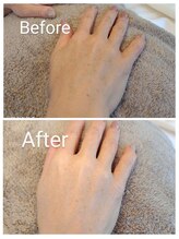 クラリス(Clarice)/手にもピーリング/AHAピーリング