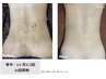 背中美人！背中ブツブツケアと背中脱毛1回分のセットクーポン◎
