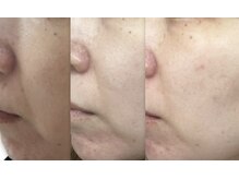 フェリス(feliz)/Before After[美肌フェイシャル]