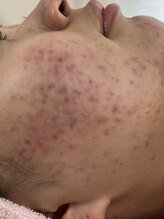 ピュアージュ/ハーブピーリング