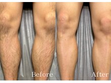 シルビー(CILBE)/脚MIX脱毛