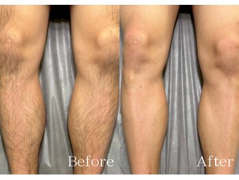 シルビー(CILBE)/脚MIX脱毛