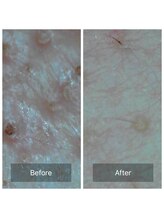 ルシェルブルー(Le ciel bleu)/炎症レス＊毛穴洗浄♪