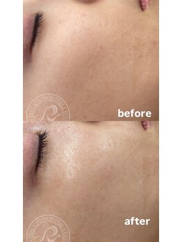 セレネ(SELENE)/乾燥、毛穴悩み