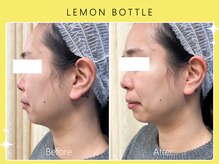 シロカネ 光の森店(SHIROKANE)/レモンボトル×小顔コルギ☆