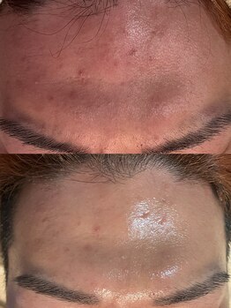 ミニョンプラス(Mignon+)/1回でこの効果肌！男性にも人気