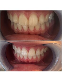 エクシアホワイトニング 代々木店/ホワイトニングビフォーアフター