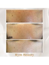 リム ビューティー(RYM BEAUTY)/ダクトピールで毛穴ケア