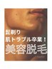 札幌最安【他メニューとの組み合わせで】ヒゲ光脱毛500円！！