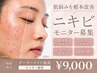 【ニキビ肌モニター】肌状態別オーダーメイドケア ¥9,000