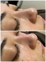 アネル 美里店(anel)/最新のハイドロで毛穴ケア