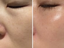 ミルジュ(MiLuJu)/マーメイドセルトリートメント